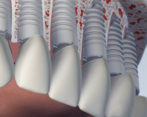ilustración de la mandíbula superior: Todos los dientes faltantes reemplazados con implantes dentales individuales