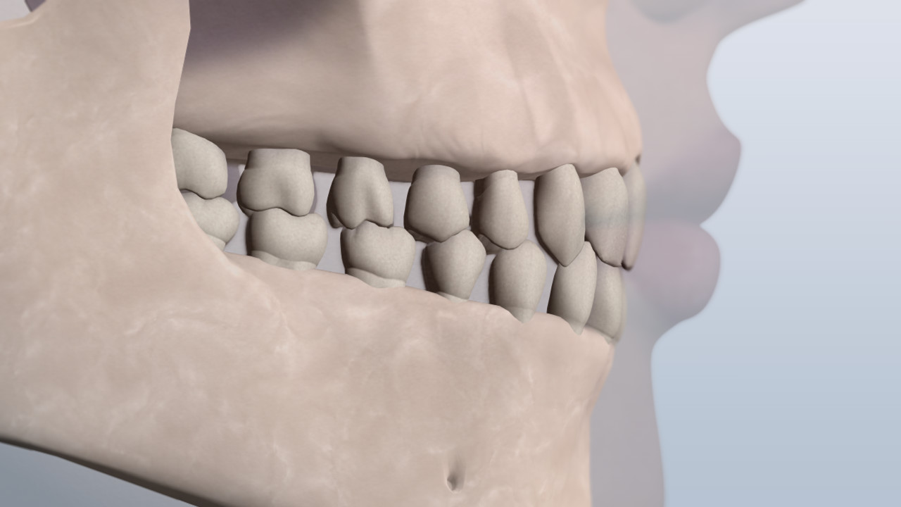 Una imagen de una mandíbula con dientes demasiado espaciados en una clase. 1 relación