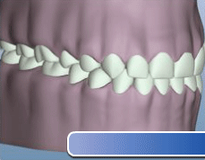 Animated gif of a Tooth Crown Lengthening procedure on the lower gums