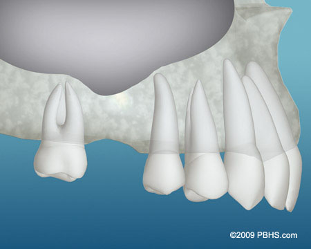 A jaw lacking enough bone in the back of the mouth for a dental implant