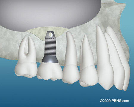 Un exemple d'implant dentaire après l'ajout de la structure de la mâchoire avec greffe osseuse