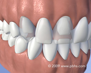 Digital illustration: fixed Bridge, dental bridge