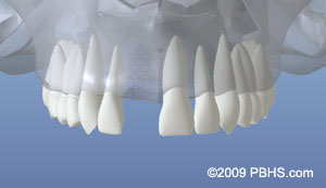 癒合的上顎骨的鬆動牙齒後的表示