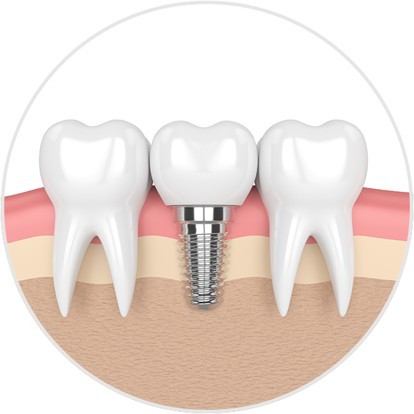 Dental Implant Illustration of implant between two natural teeth